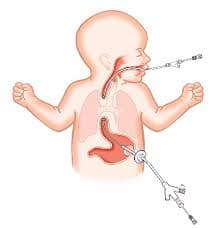 بن بست مری (آترزی مری ) - جزوه آموزشی