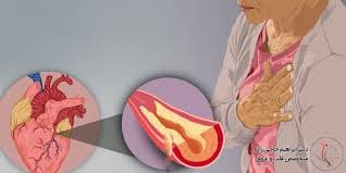 بیماری عروقی قلب (سندرم عروق کرونری )