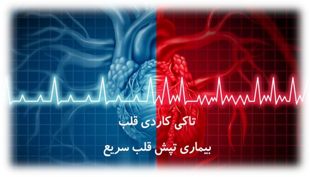 تاکی کاردی فوق بطنی (پمفلت)
